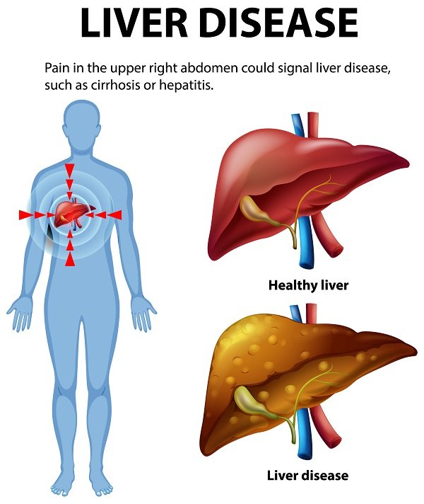 Illustration showing liver disease, including a comparison of a healthy liver and a diseased liver, and a human body highlighting pain in the upper right abdomen.