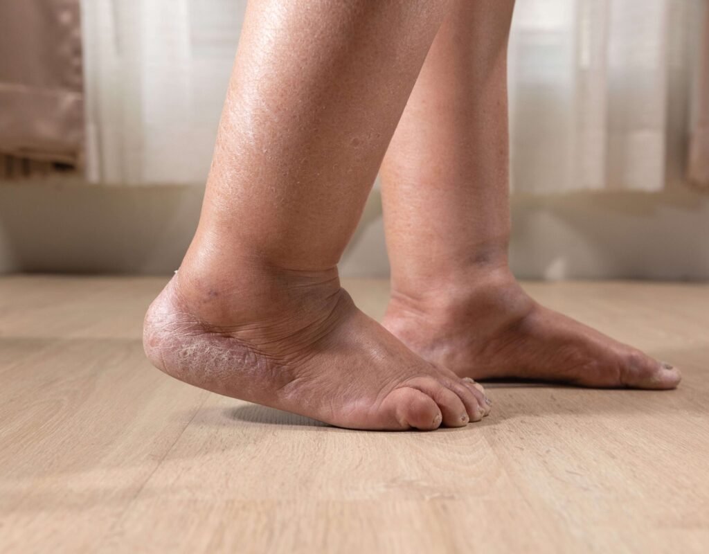 Close-up view of swollen feet and ankles showing visible edema and dry, cracked skin on the heels.